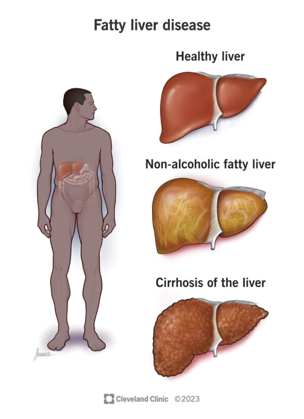 Fatty Liver??? No Problem now: Curing Fatty Liver by Using Vegetables: A complete Guide